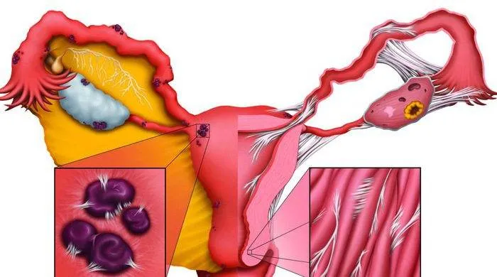 10 cách phân biệt đau bụng kinh và đau do lạc nội mạc tử cung: Chẩn đoán và điều trị