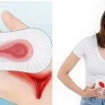 5 Bước Xử Lý Khẩn Cấp Khi Chảy Máu Âm Đạo Bất Thường