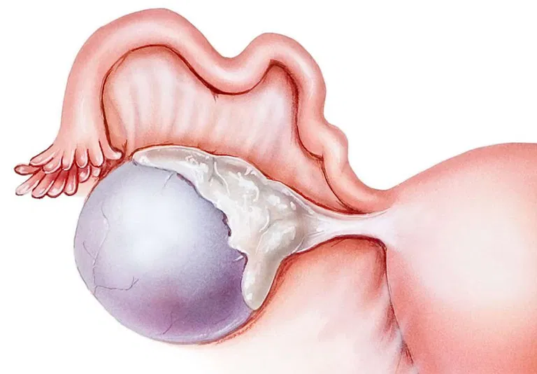 Biến chứng của u nang buồng trứng Biến chứng của u nang buồng trứng