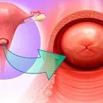 Viêm lộ tuyến cổ tử cung