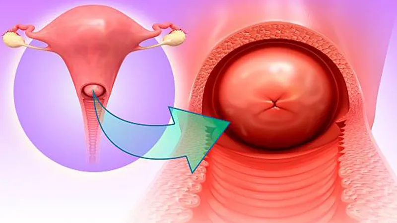 Viêm lộ tuyến cổ tử cung